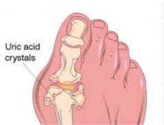 Guta, o consecinta a stilului de viata 1 Guta, o consecinta a stilului de viata 1